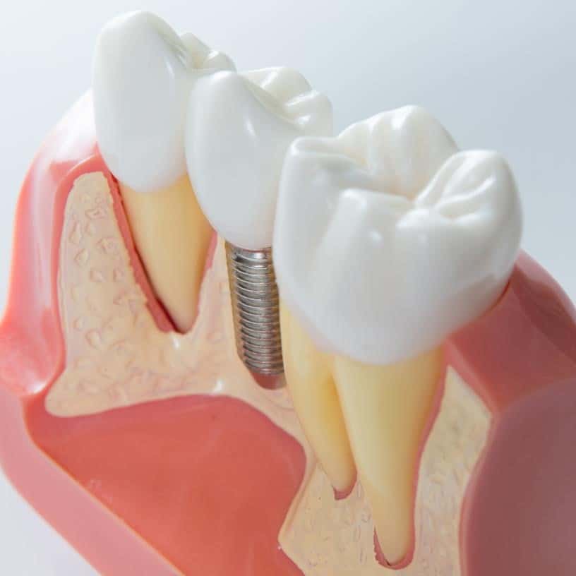 Dental Implants Near Me - Johnson Family Dental